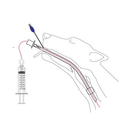Lavado Traqueal y Broncoalveolar